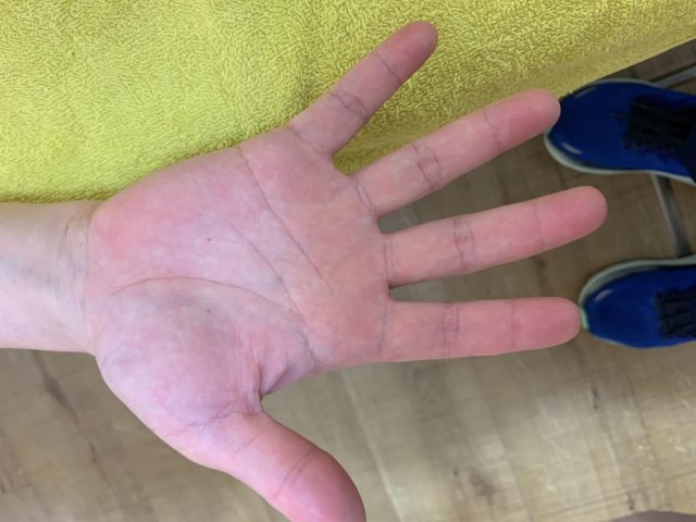 主婦湿疹　異汗性湿疹　汗疱状湿疹