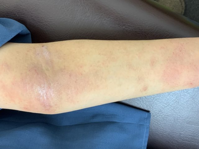 主婦湿疹　異汗性湿疹　汗疱状湿疹