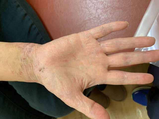 主婦湿疹　異汗性湿疹　汗疱状湿疹