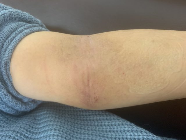 主婦湿疹　異汗性湿疹　汗疱状湿疹