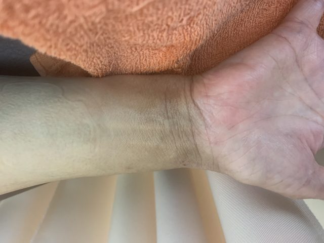 主婦湿疹　異汗性湿疹　汗疱状湿疹
