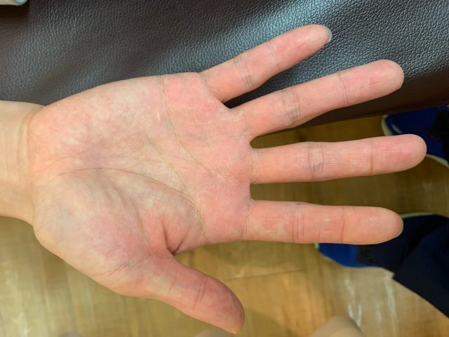 異汗性湿疹　手荒れ　主婦湿疹　汗疱状湿疹