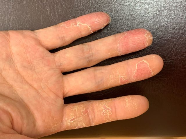 異汗性湿疹　手荒れ　主婦湿疹　汗疱状湿疹