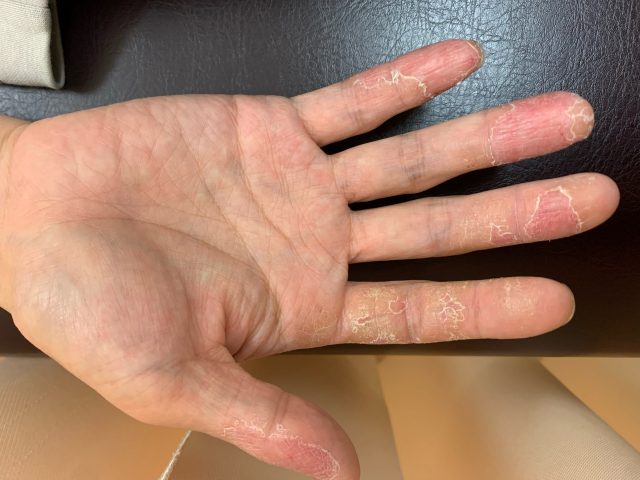 異汗性湿疹　手荒れ　主婦湿疹　汗疱状湿疹